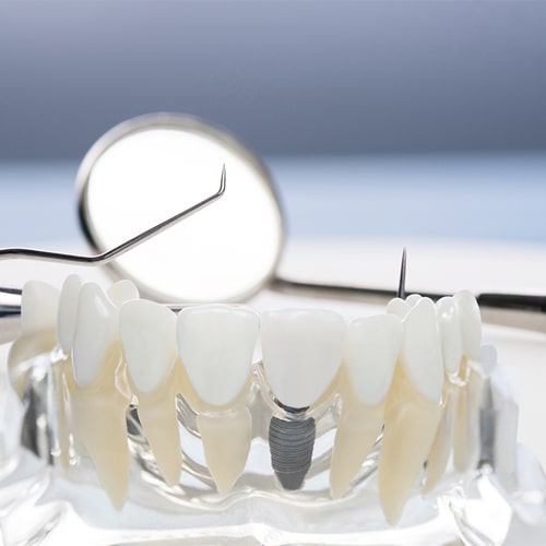delta dentistry implant services in delta