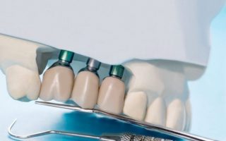 7 Most Important Facts About Dental Implants
