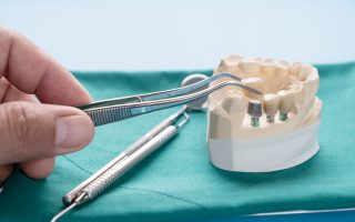 Frequently Questions about Dental Implants