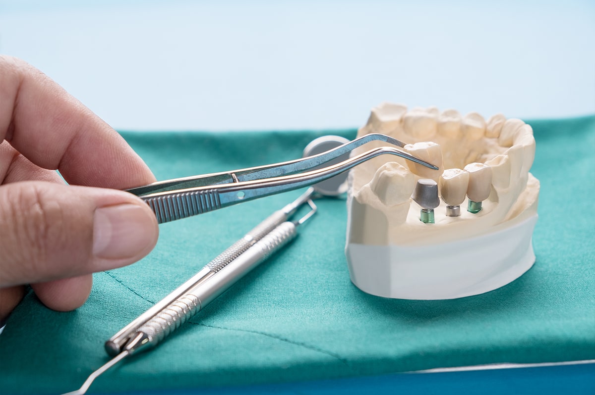 Frequently Questions about Dental Implants Delta Dentistry