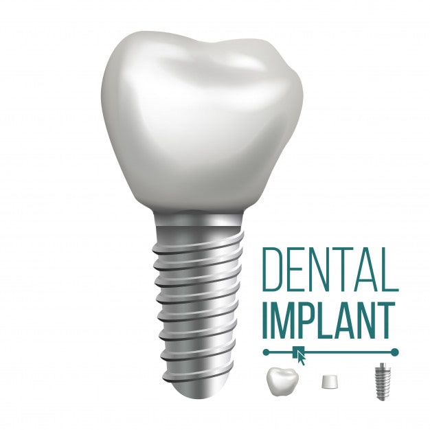 dental implants knowledge base