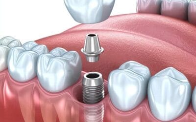 Can Smokers Get Dental Implants?