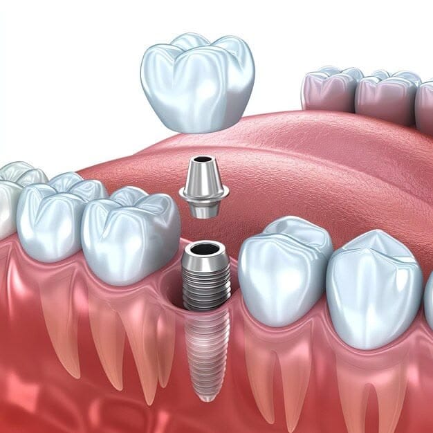 Can Smokers Get Dental Implants?