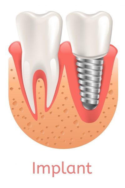 Dental Implants in Delta